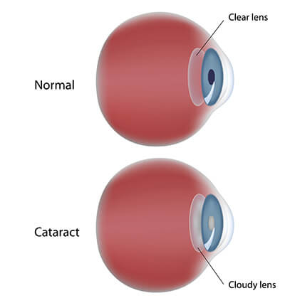 Chart Showing a Healthy Eye Compared to One With a Cataract