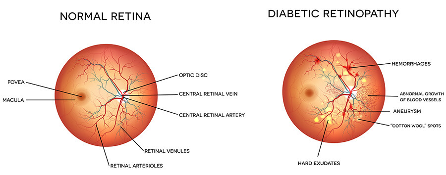 Chart Showing a Healthy Eye Compared to One With Diabetic Retinopathy