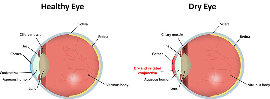 Chart Showing a Healthy Eye Compared to One With Dry Eye
