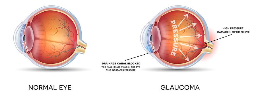 Chart Showing a Healthy Eye Compared to One With Glaucoma